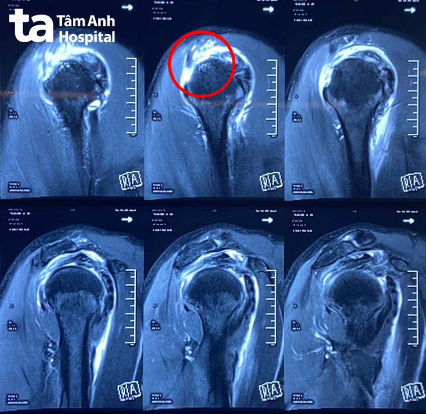 Ghép gân vai bằng mảnh ghép bì đồng loại | BVĐK Tâm Anh