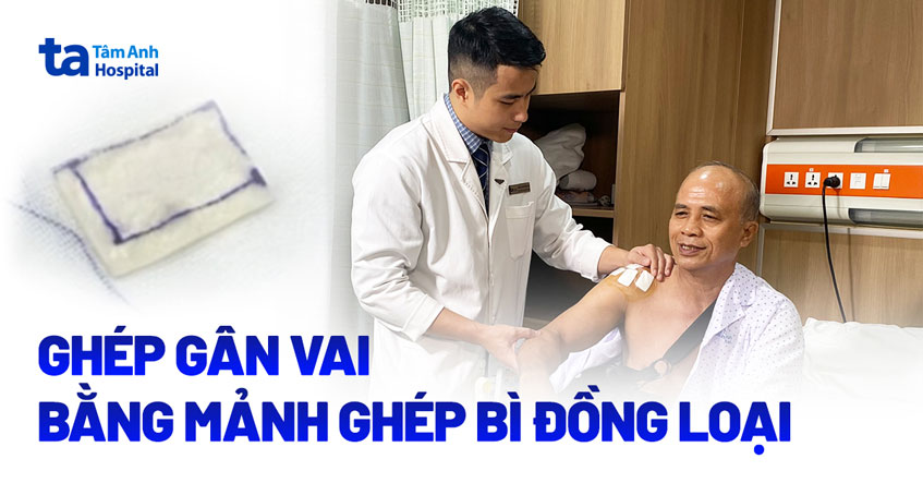 Ghép gân vai bằng mảnh ghép bì đồng loại