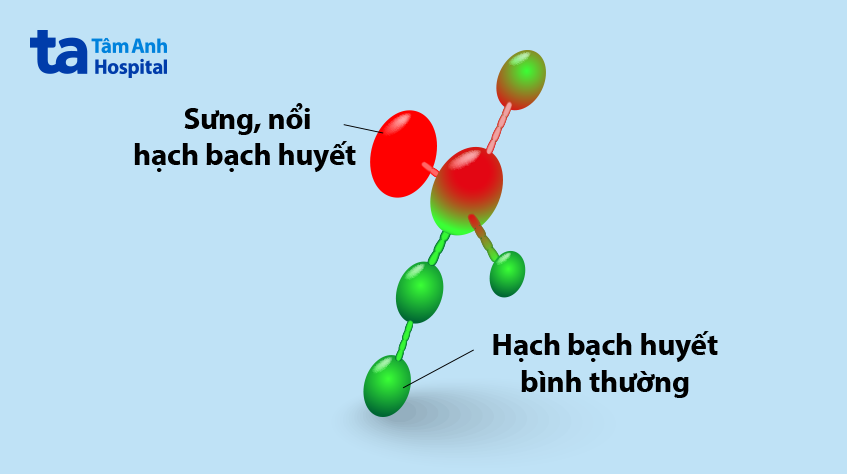 Hạch nổi ở cằm có thể có kích thước nhỏ hoặc lớn