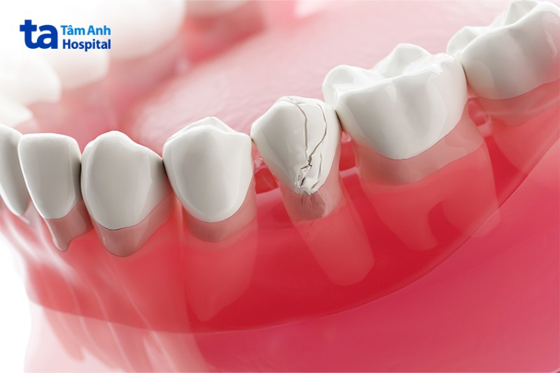 Nguyên nhân gây mất răng, nứt vỡ răng