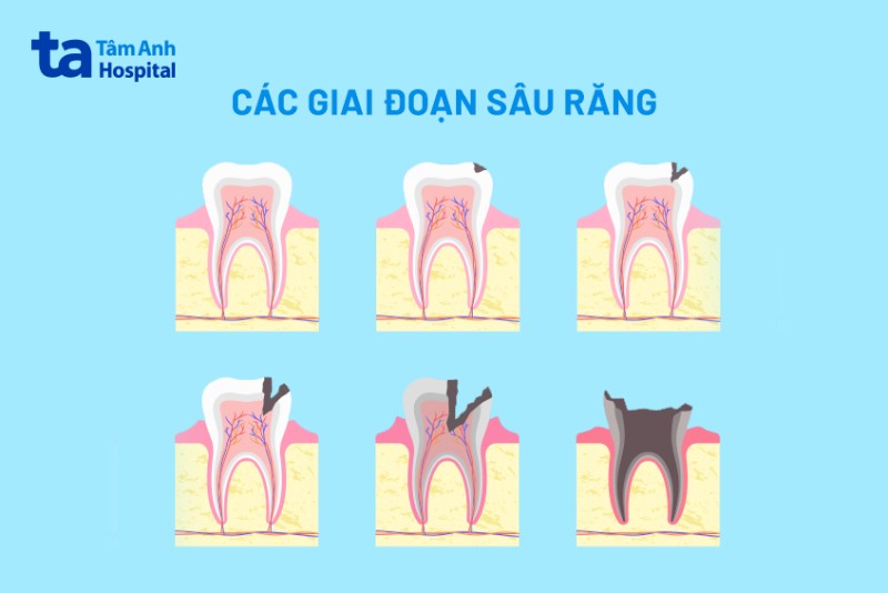 Nguyên nhân gây mất răng, sâu răng
