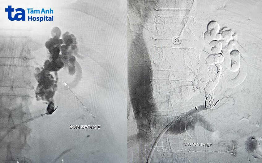 hình ảnh can thiệp nội mạch