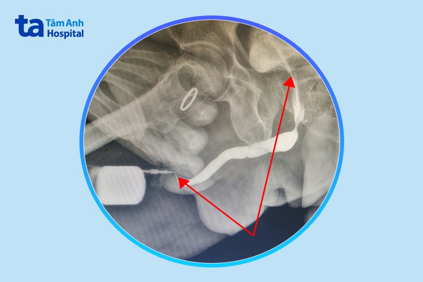 hình ảnh chụp x - quang niệu đạo