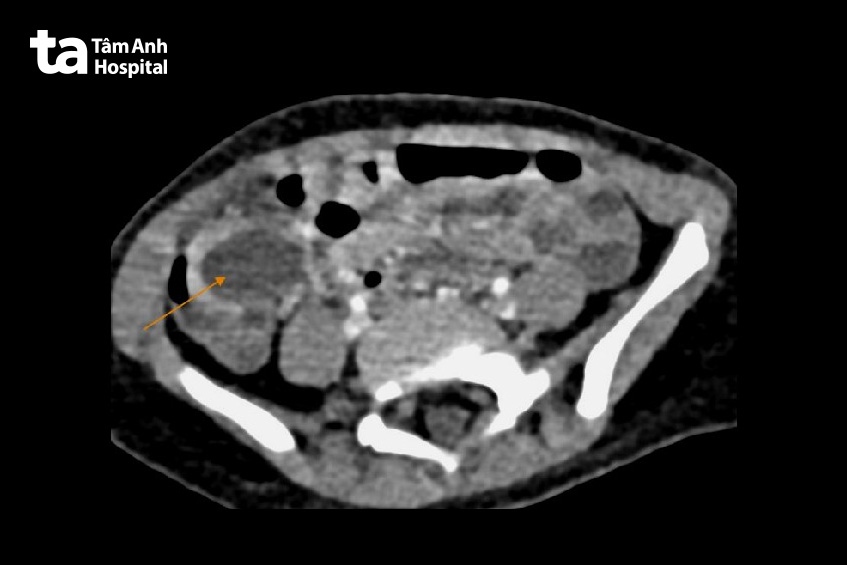 Hình ảnh CT của bé Thanh ghi nhận khối u bất thường ở ruột