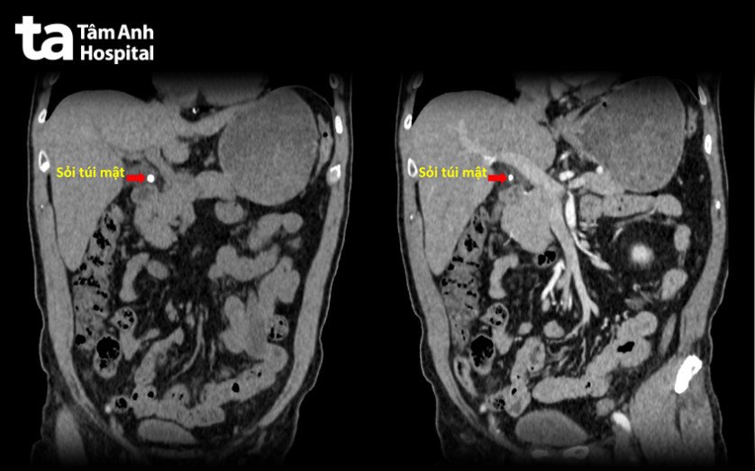 hình ảnh ct sỏi túi mật