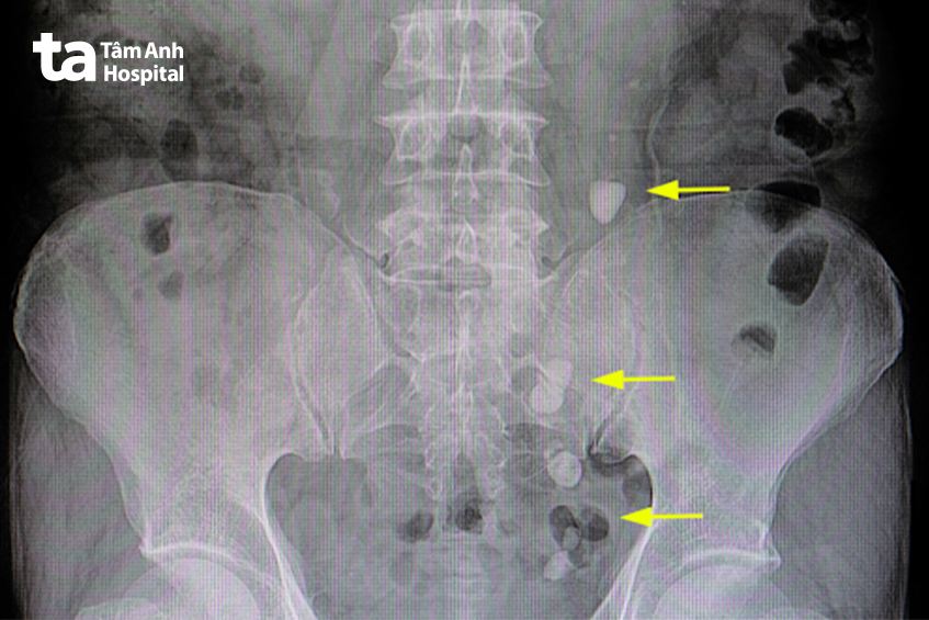hình ảnh xquang sỏi niệu quản