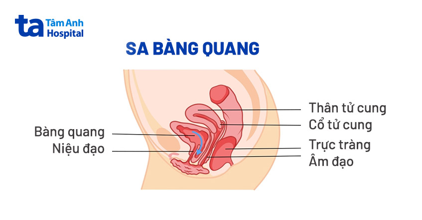 Hình minh họa sa bàng quang
