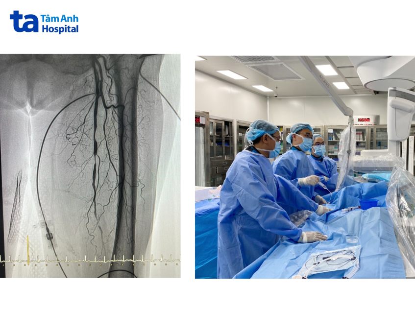 hỗ trợ cải thiện tăng tưới máu nuôi chi dưới