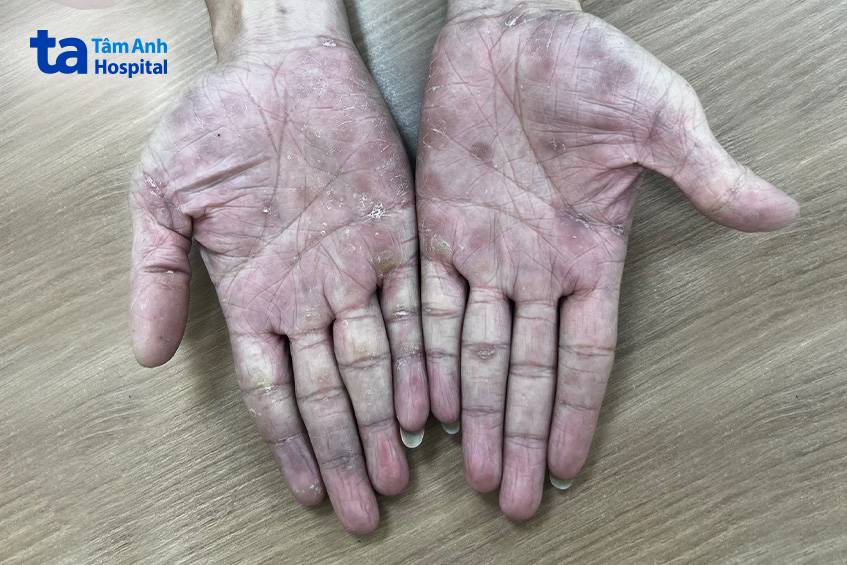 hồng ban sẩn vảy ở tay người bệnh giang mai