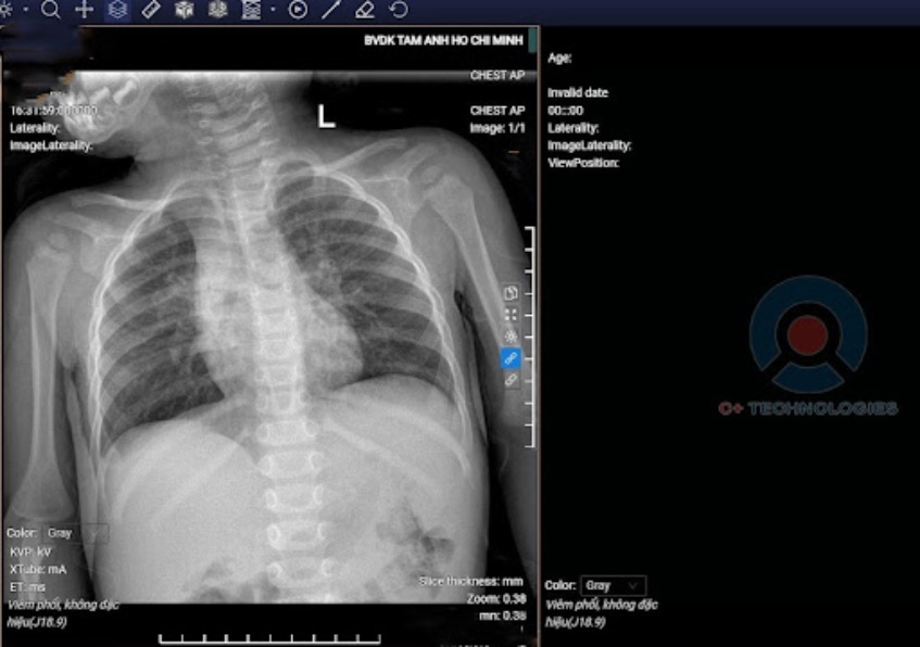 Kết quả X-quang phổi của bé Minh Anh xác định viêm phổi