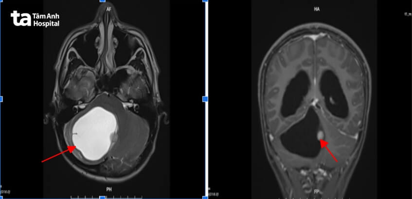 khối u não khiến nam sinh học hành sa sút
