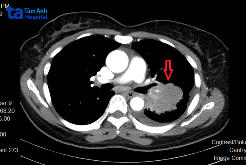 Khối u phổi của bà Liên trên phim chụp cắt lớp vi tính