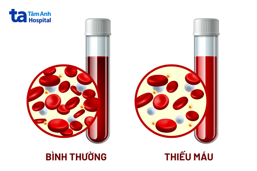 không đủ nguyên liệu sản xuất hồng cầu