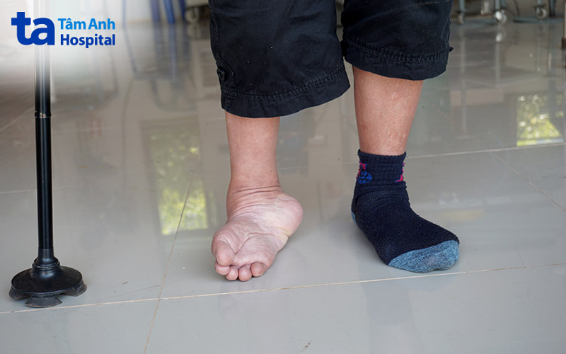 Không thể đi bằng lòng bàn chân