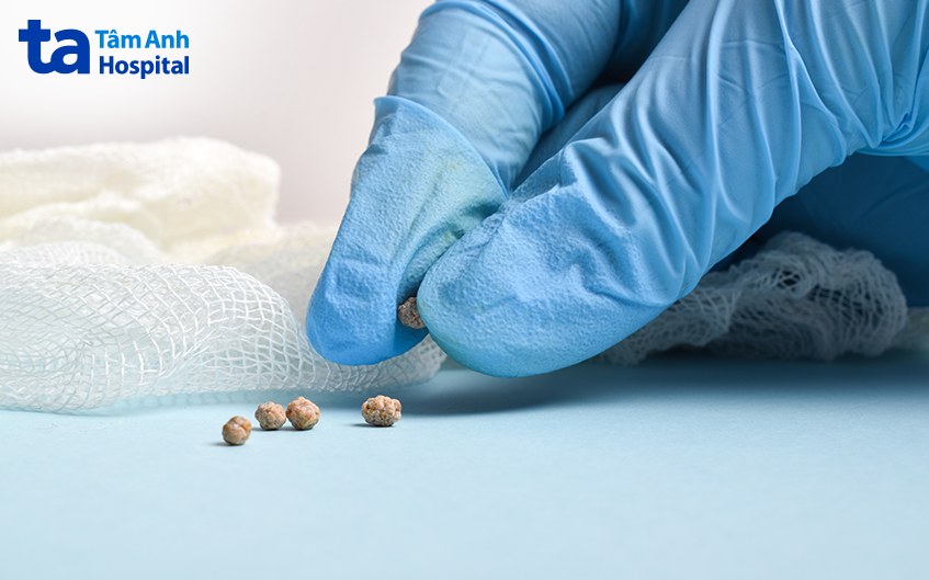 kích thước sỏi ống mật chủ