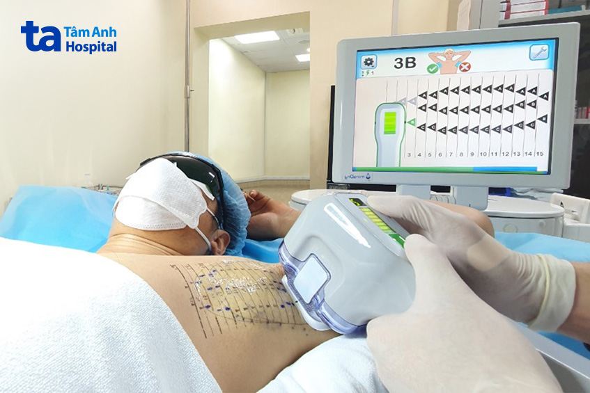 liệu trình triệt tuyến mồ hôi nách khoảnng 3 giờ