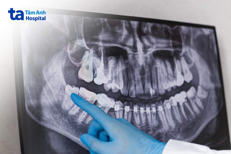 Các biện pháp chẩn đoán viêm lợi trùm