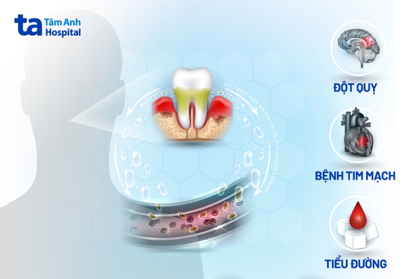 Biến chứng nguy hiểm khi viêm lợi trùm