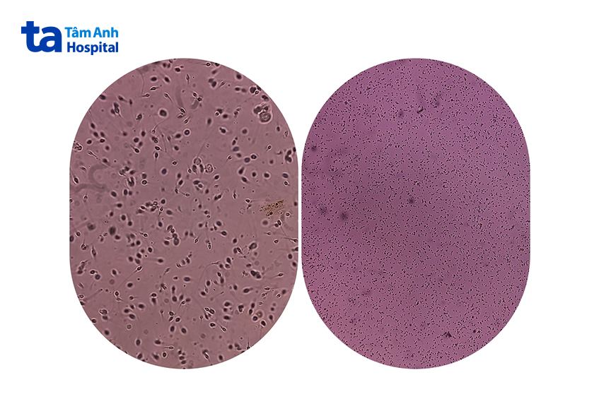 mẫu xét nghiệm tinh trùng bình thường và bất thường