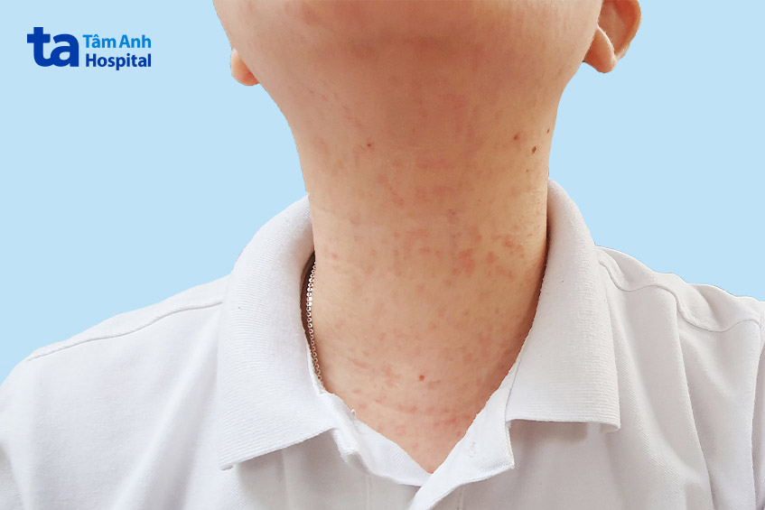 Mề đay có thể nổi ở mọi vị trí, nổi ở cổ, mặt gây mất thẩm mỹ, mặc cảm cho người bệnh