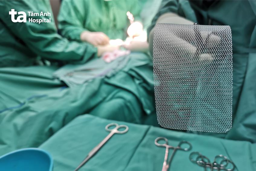 mổ thoát vị kẹt