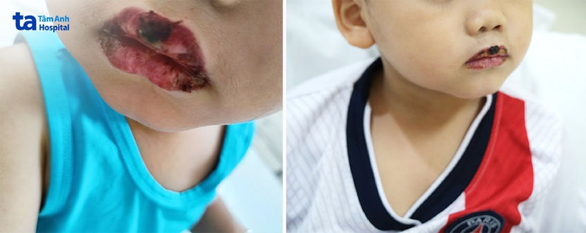 Môi bé Phong sưng phồng, loét, chảy mủ, máu