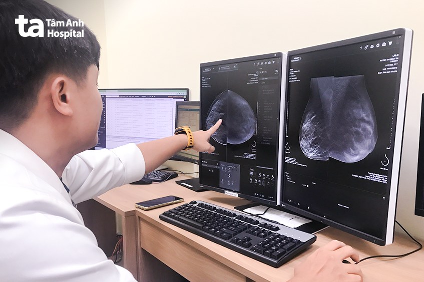 ngừa ung thư vú uống thuốc gì