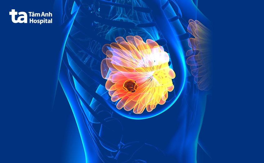 nguy cơ ung thư vú