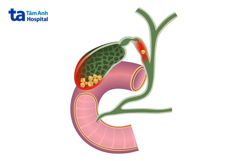 nguyên nhân tắc ống mật