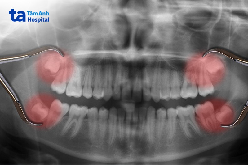 Kiểm tra và chụp X - quang răng trước khi nhổ răng số 8