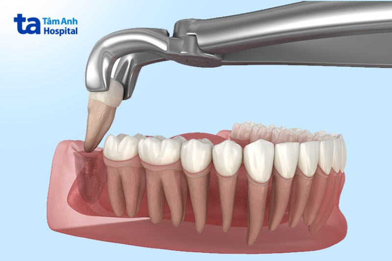 Nhổ răng số 8 là gì?