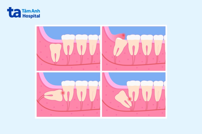 Trường hợp nên nhổ răng số 8