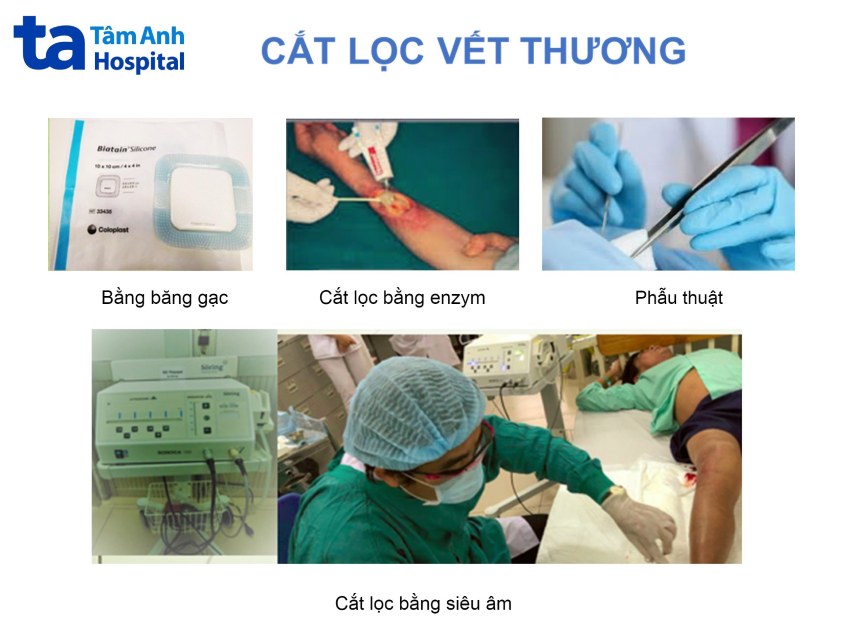Những tiến bộ trong kỹ thuật cắt lọc vết thương hiện nay