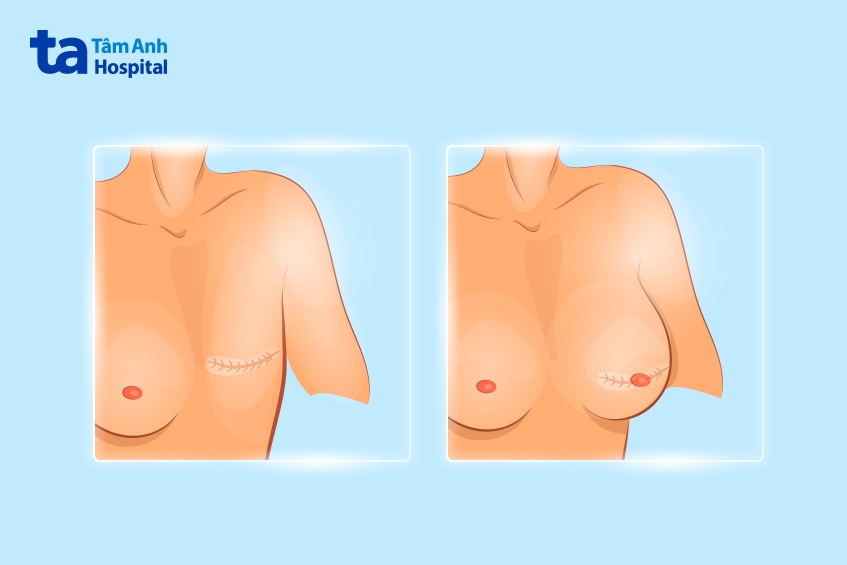 phẫu thuật chỉnh sửa tái tạo vú