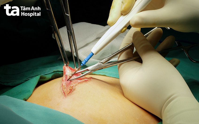 phẫu thuật thoát vị thành bụng