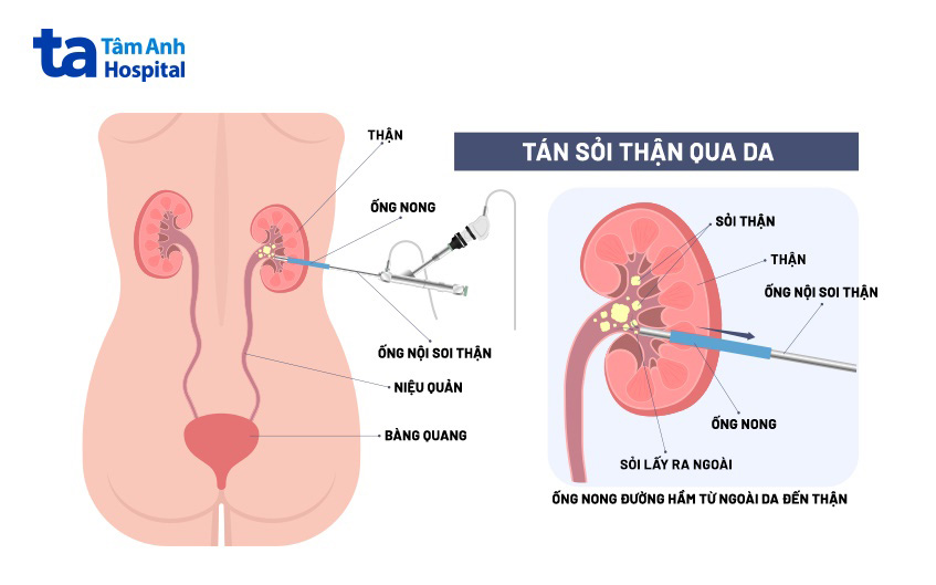 Phương pháp tán sỏi qua da
