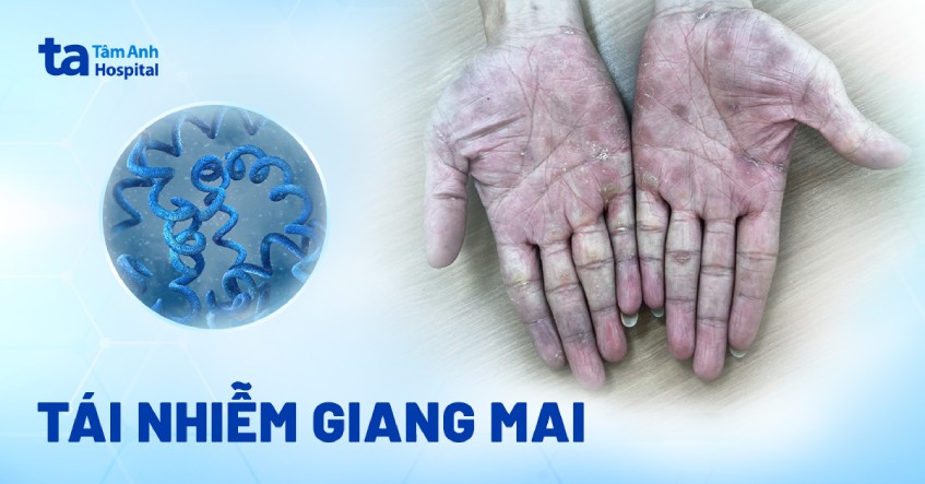 Tái nhiễm giang mai ở người quan hệ đồng giới