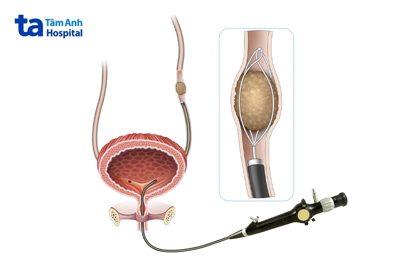 quy trình mô phỏng tán sỏi nội soi ngược dòng bằng laser