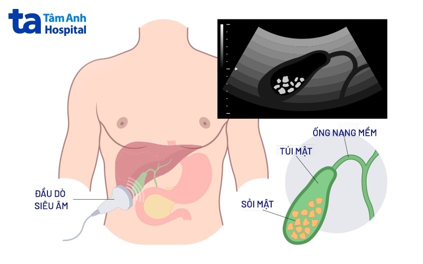 quy trình nội soi lấy sỏi ống mật chủ