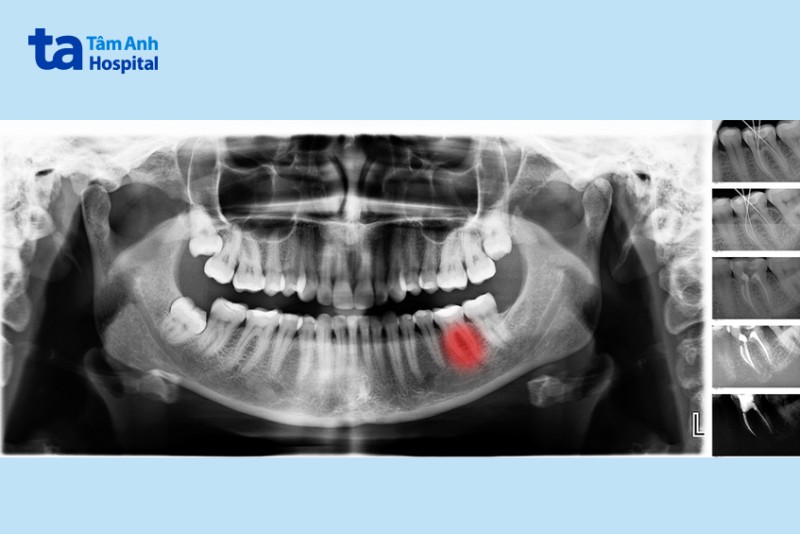 Răng số 7 là răng nào? Vị trí răng số 7
