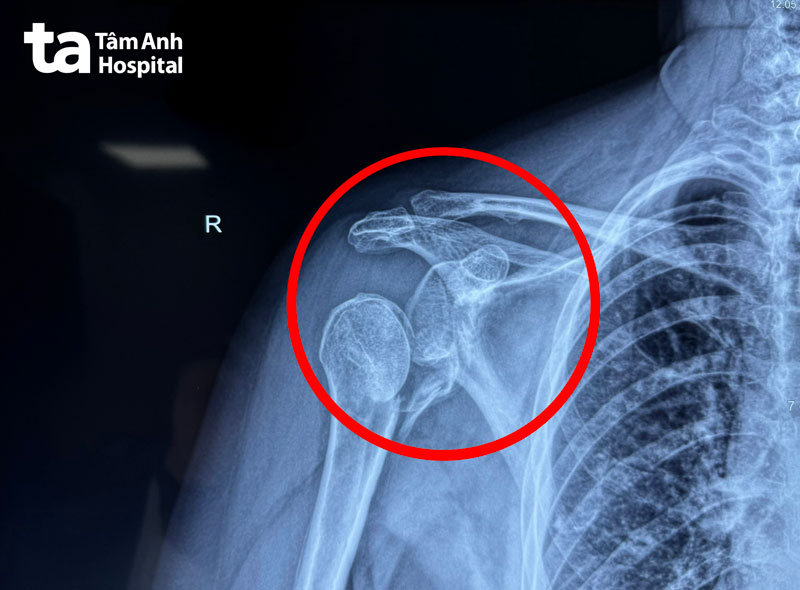 thay khớp vai nhân tạo sau điện giật té ngã