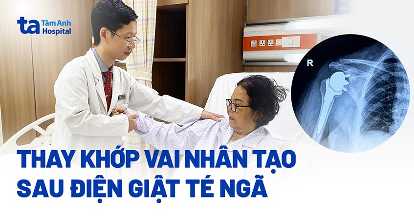 Thay khớp vai nhân tạo sau điện giật té ngã