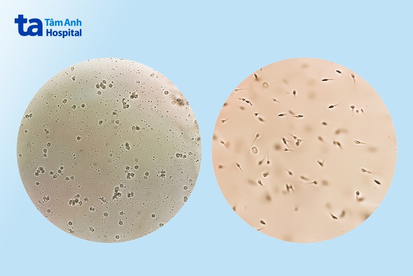 tiêu chí lựa chọn địa chỉ xét nghiệm tinh dịch đồ