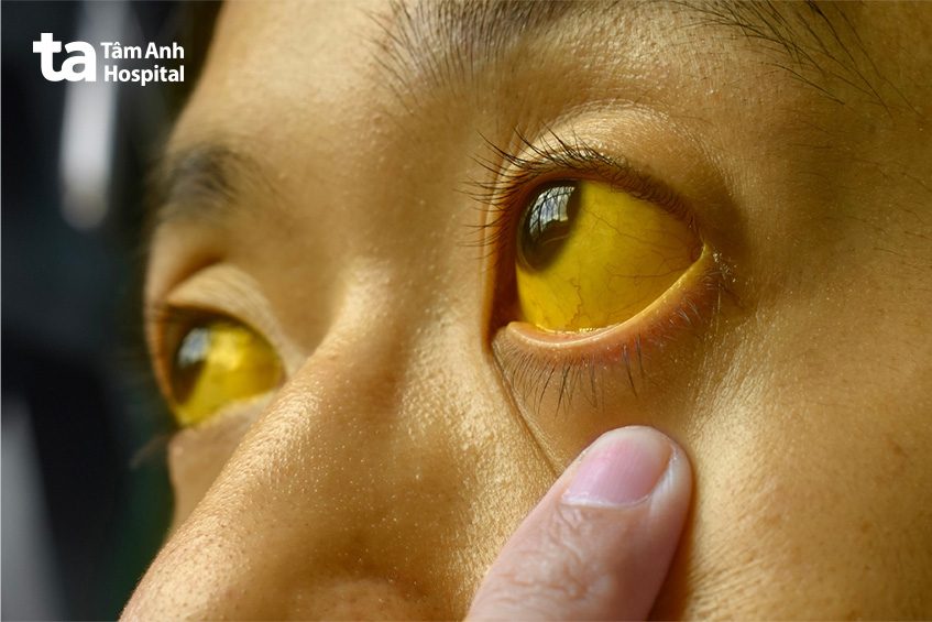 triệu chứng tắc ống mật