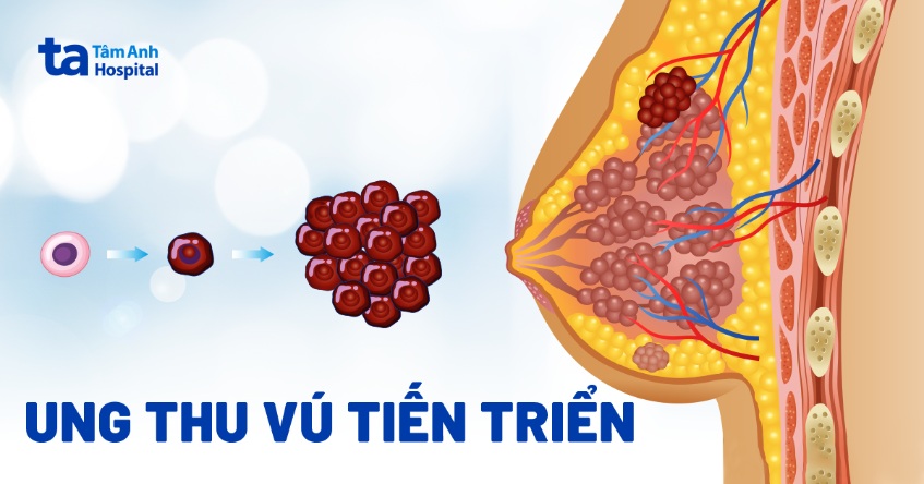 ung thư vú tiến triển