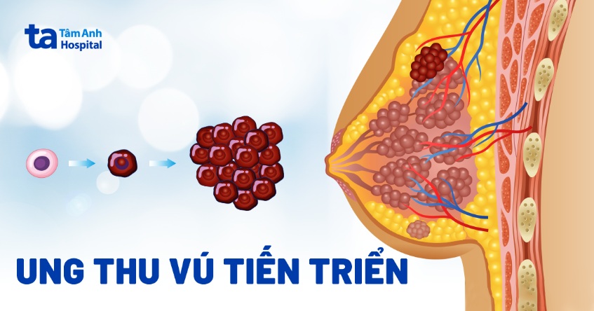 Ung thư vú tiến triển: Nguyên nhân, điều trị và tiên lượng bệnh