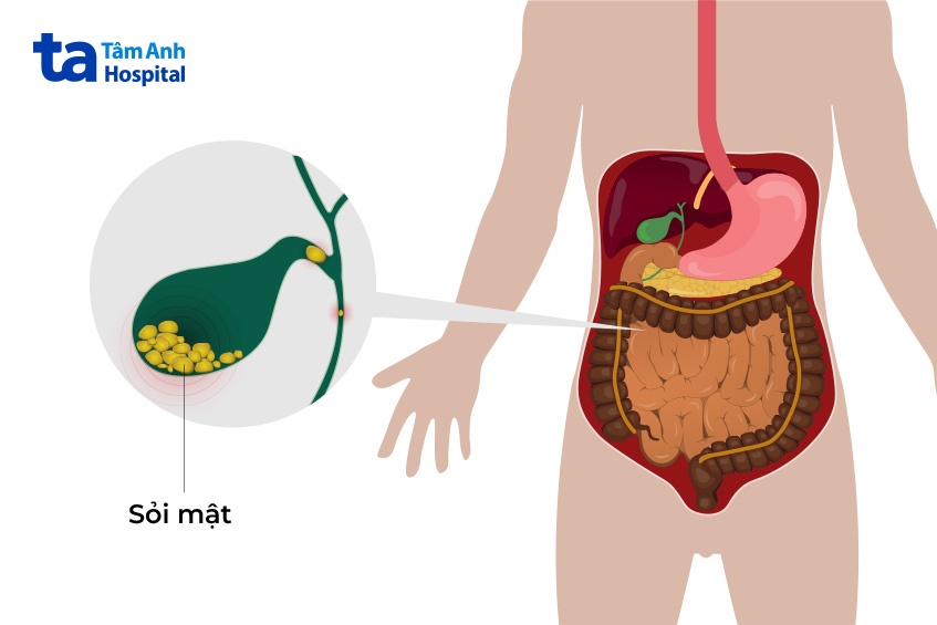 vàng da do tắc mật