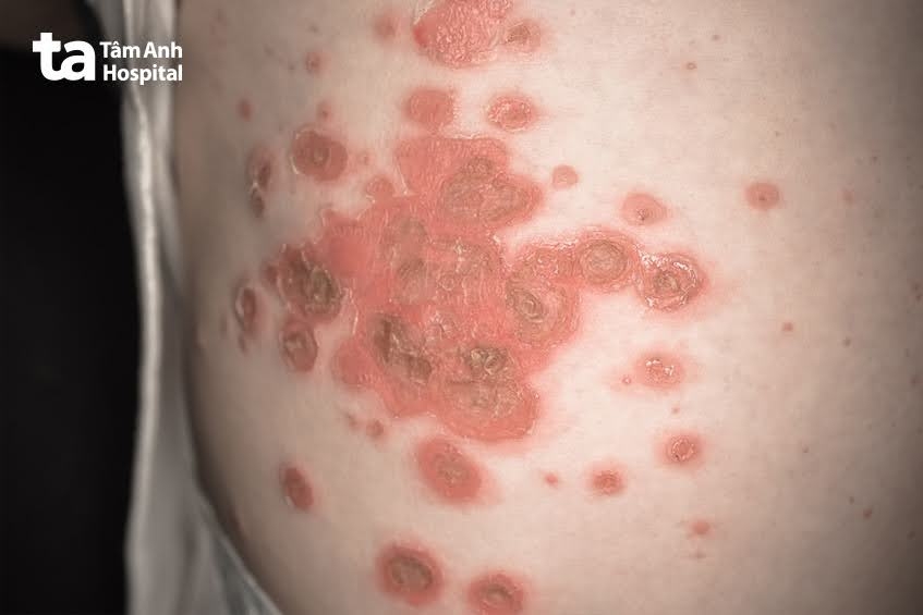 vảy phấn đỏ nang lông có nguy hiểm không