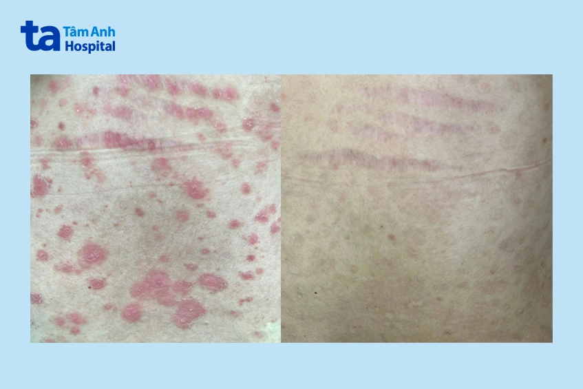 vùng lưng chị k trước và sau khi điều trị