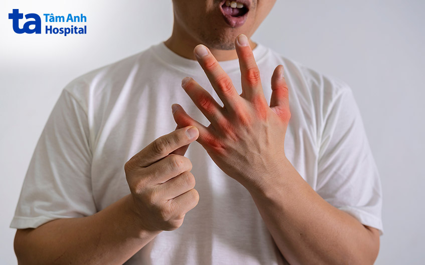 Xét nghiệm hỗ trợ bác sĩ trong chẩn đoán bệnh gout